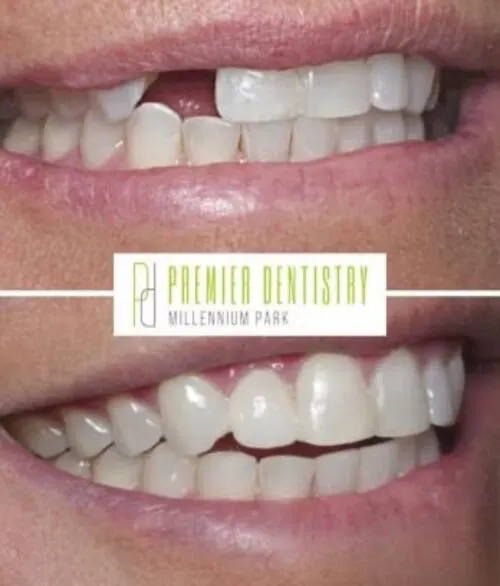Premier chicago 29 - Cosmetic Dentistry Before & After Photos