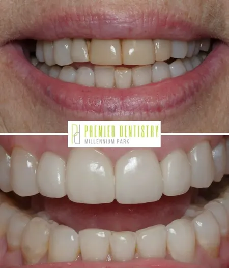 Dental patient before and after porcelain veneers from Premier Dentistry at Millennium Park