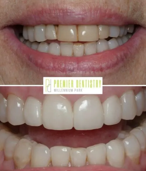 Premier chicago 30 - Cosmetic Dentistry Before & After Photos