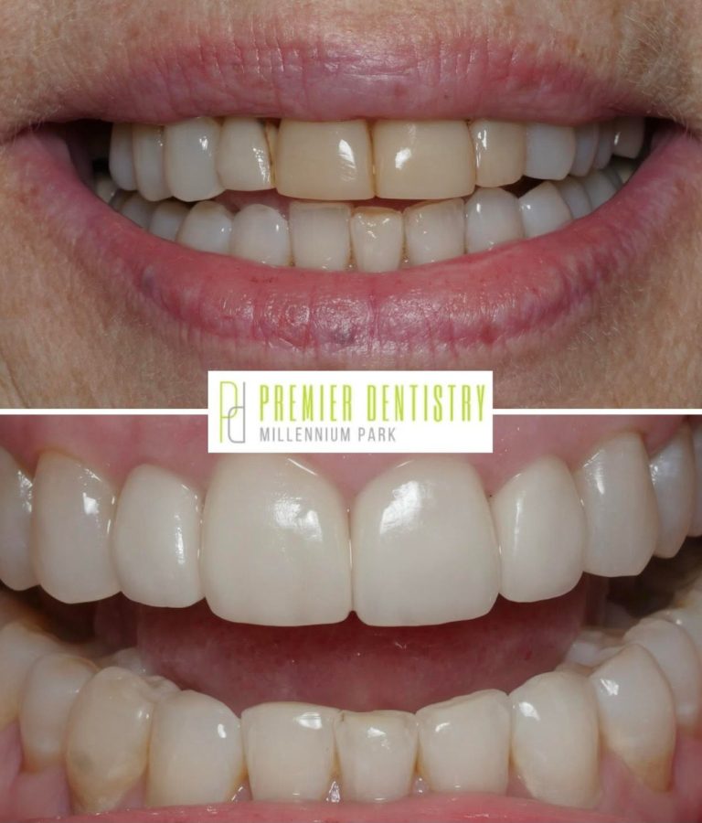 Dental patient before and after porcelain veneers from Premier Dentistry at Millennium Park