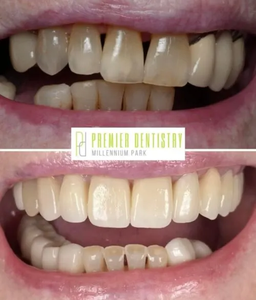 Premier chicago 31 - Cosmetic Dentistry Before & After Photos