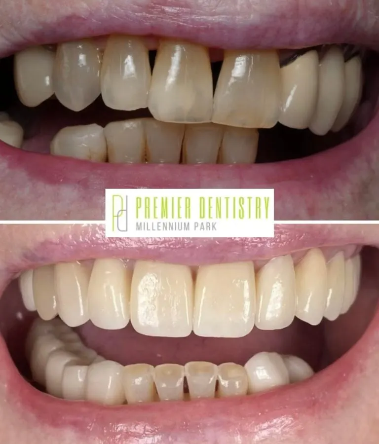 Patient before and after dental bonding from Premier Dentistry at Millennium Park