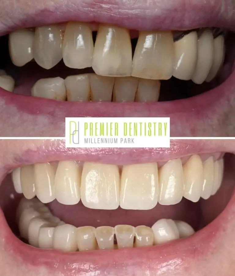 Patient before and after dental bonding from Premier Dentistry at Millennium Park