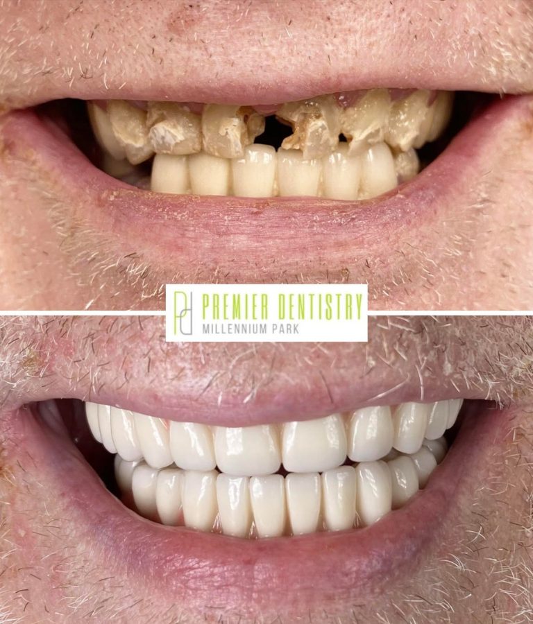 Dental patient before and after dental care at Premier Dentistry at Millennium Park