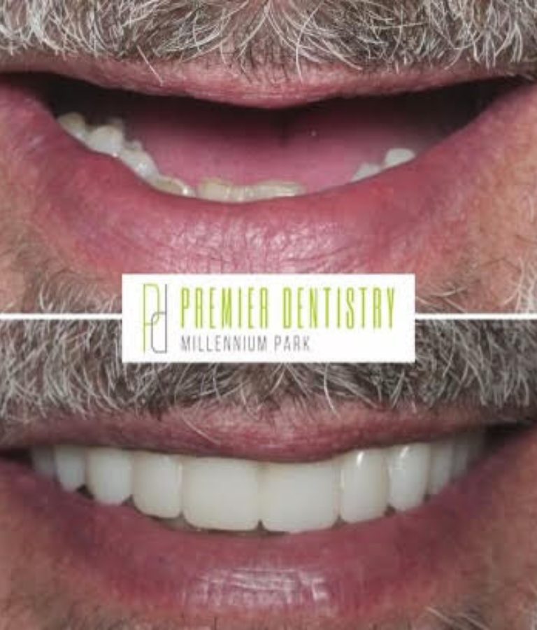 Dental patient before and after restorative dentistry from Premier Dentistry at Millennium Park