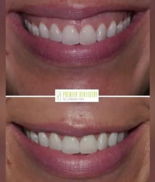 Premier chicago 34 - Cosmetic Dentistry Before & After Photos