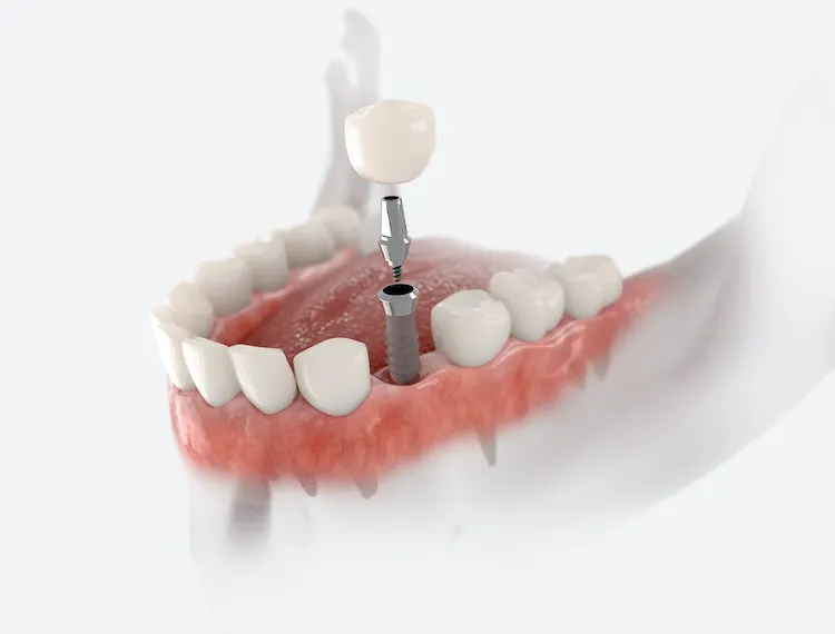 Dental crown, abutment and implant. 3D illustration of human teeth and dentures on white background.