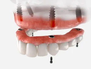 Dental Implants: A Solution for Missing Teeth in Chicago Loop, IL